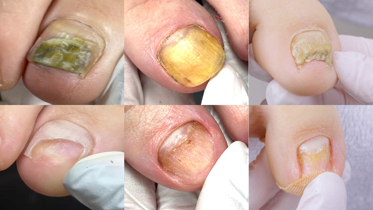 Voetschimmel herkennen en behandelen: gids voor pedicures